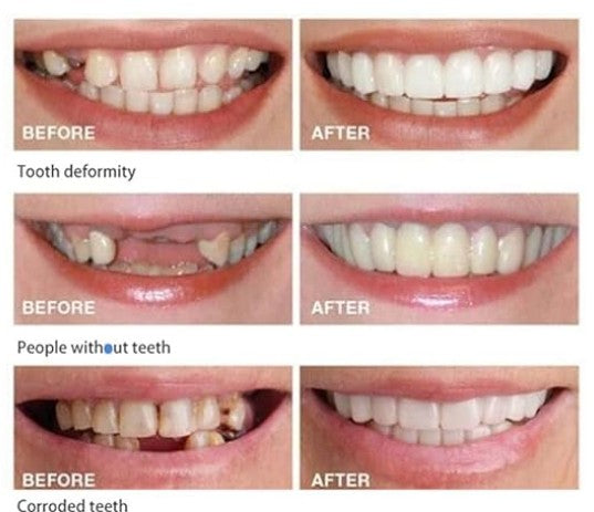 CARILLAS DENTALES Snap-On Smile