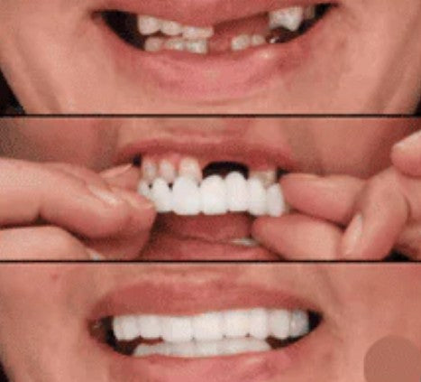 CARILLAS DENTALES Snap-On Smile