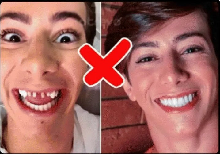 CARILLAS DENTALES Snap-On Smile