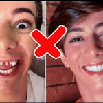 CARILLAS DENTALES Snap-On Smile