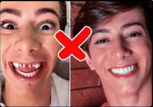 CARILLAS DENTALES Snap-On Smile
