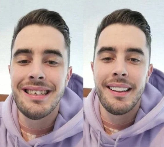 CARILLAS DENTALES Snap-On Smile
