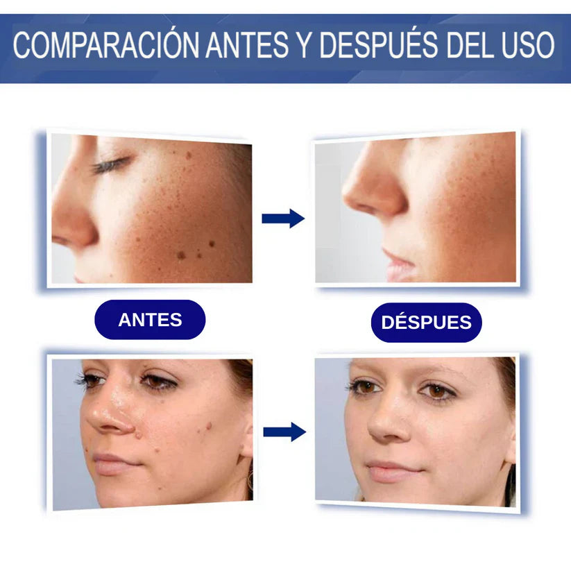 GEL WART REMOVER ELIMINA VERRUGAS, LUNARES Y MANCHAS DE TU PIEL